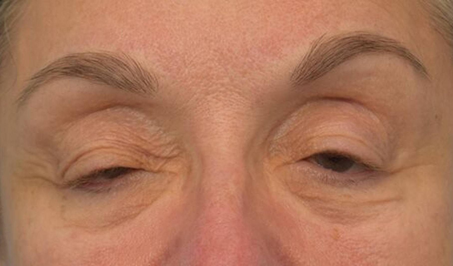 Blepharoplasty Before & After Image