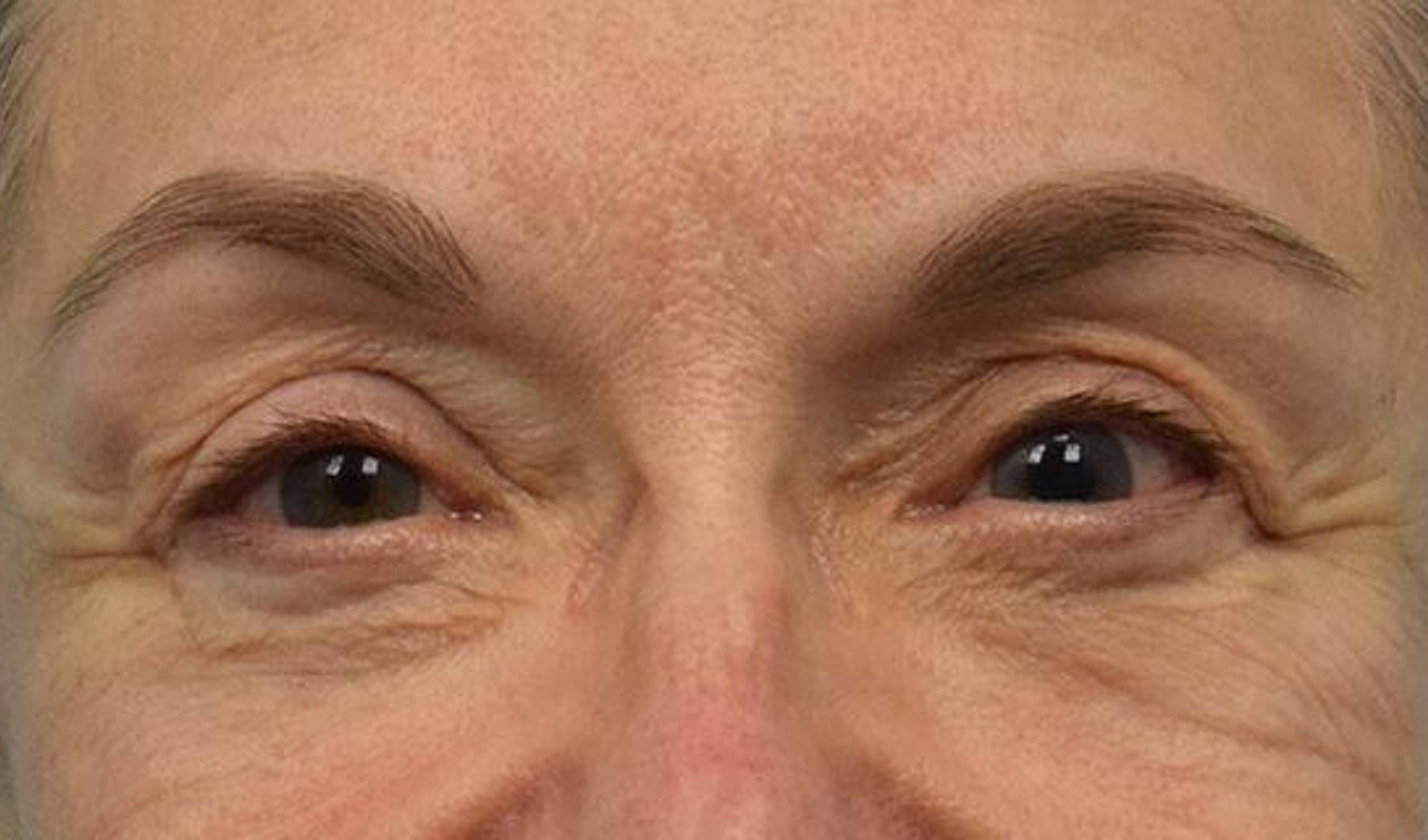 Blepharoplasty Before & After Image