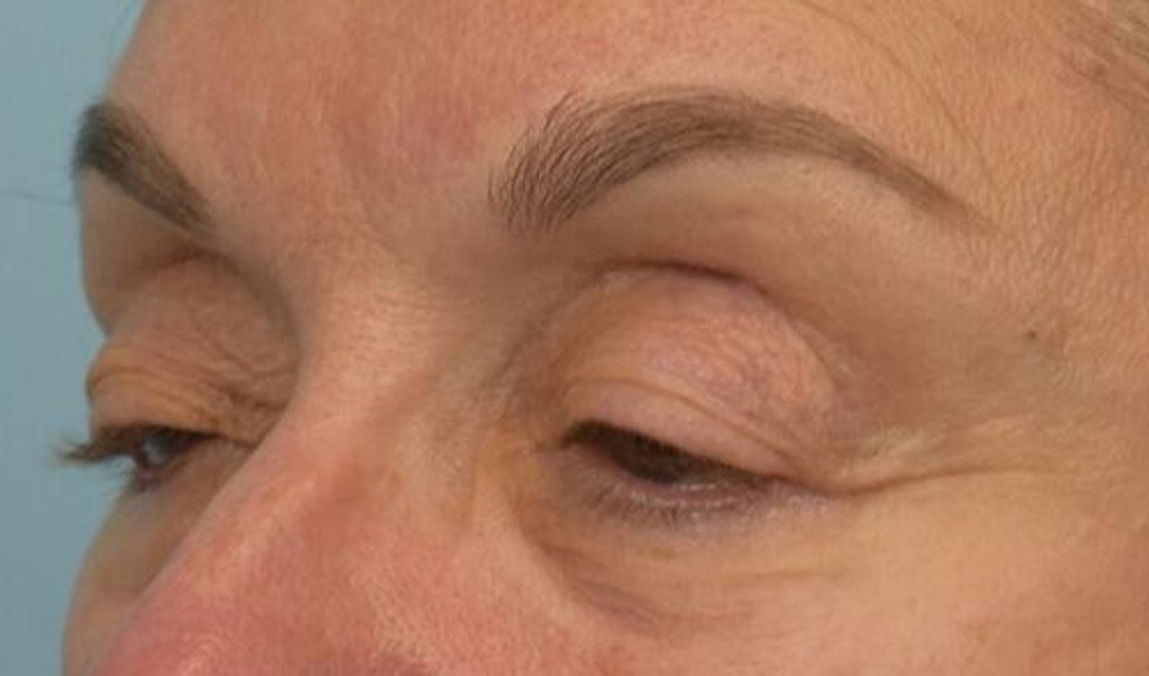 Blepharoplasty Before & After Image