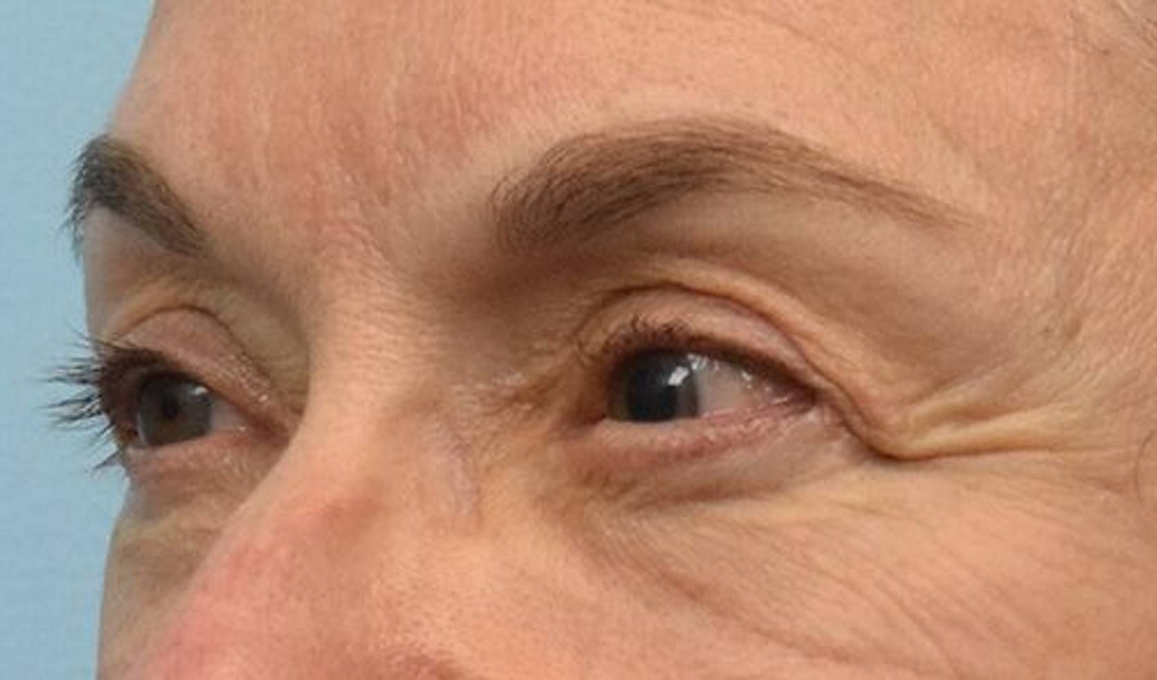 Blepharoplasty Before & After Image