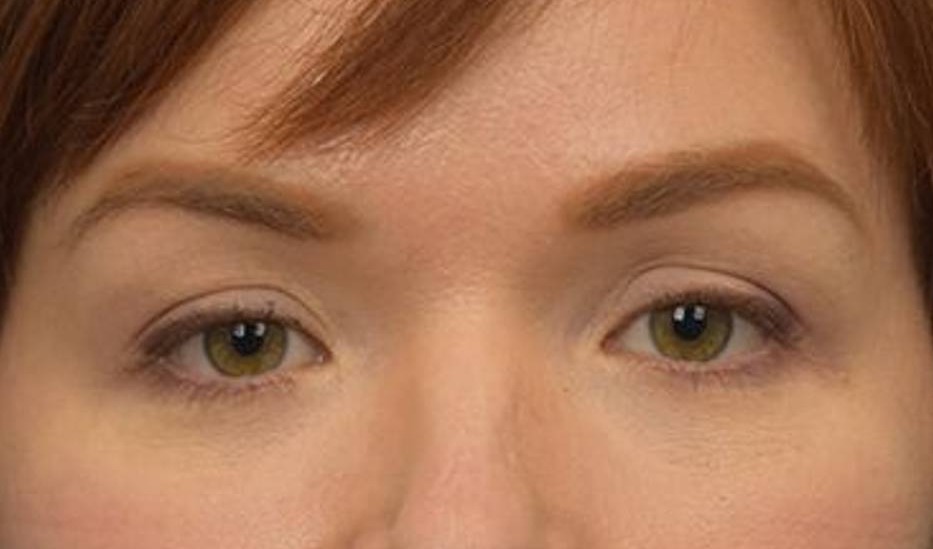 Blepharoplasty Before & After Image