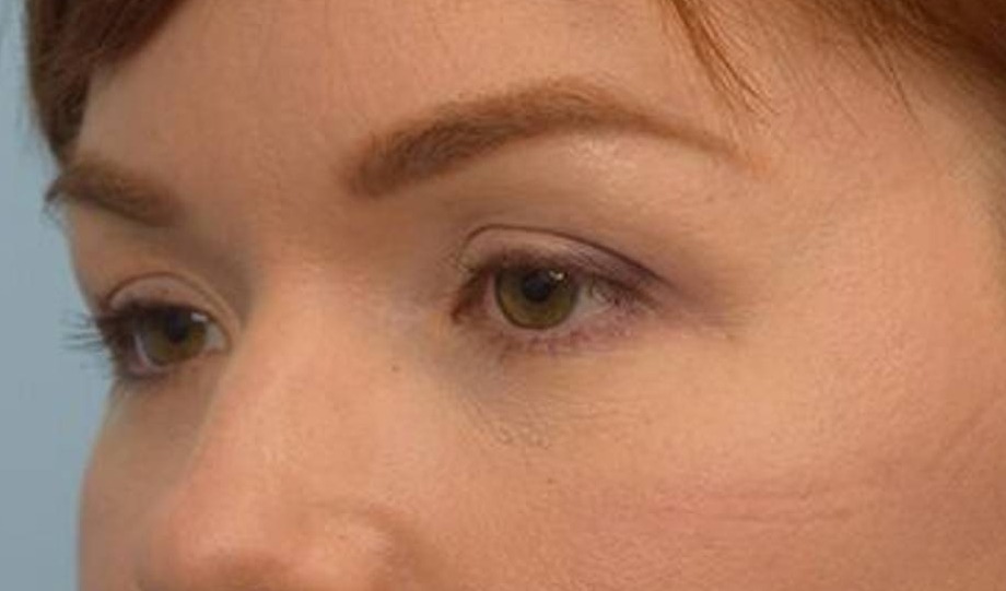 Blepharoplasty Before & After Image