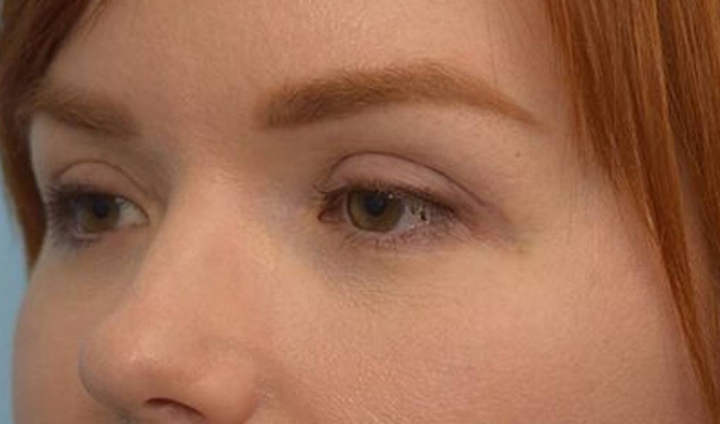 Blepharoplasty Before & After Image