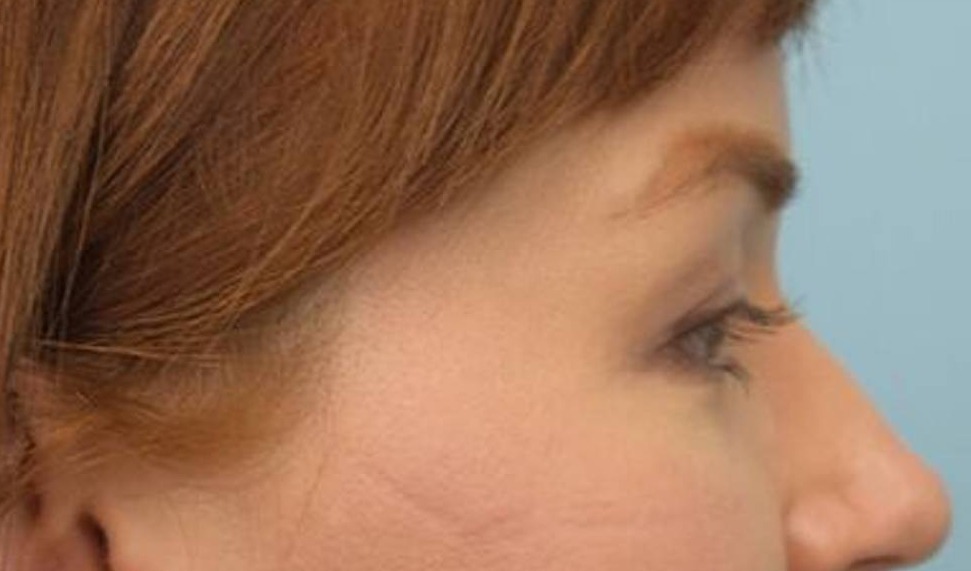 Blepharoplasty Before & After Image