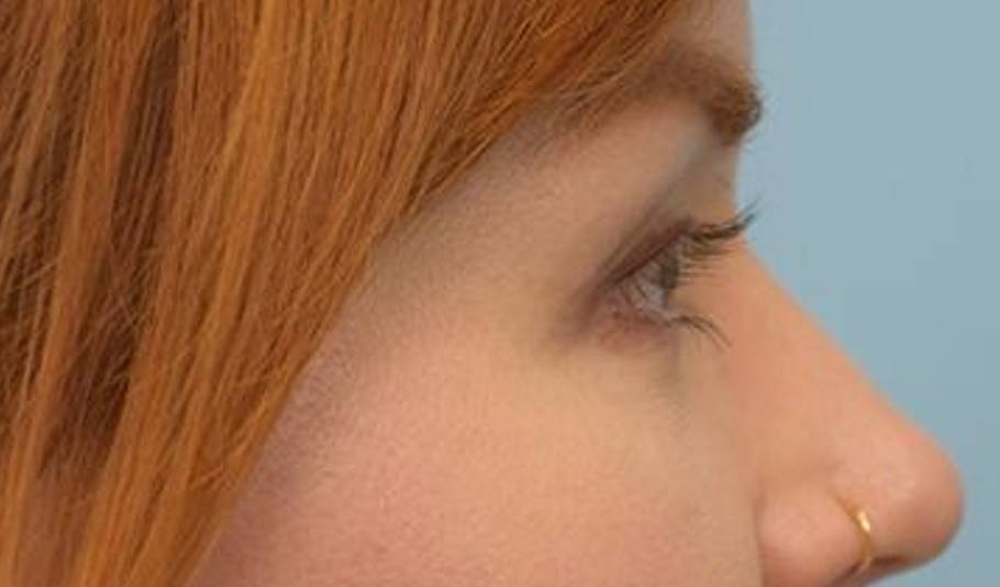 Blepharoplasty Before & After Image