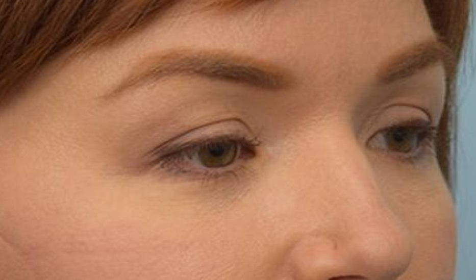 Blepharoplasty Before & After Image