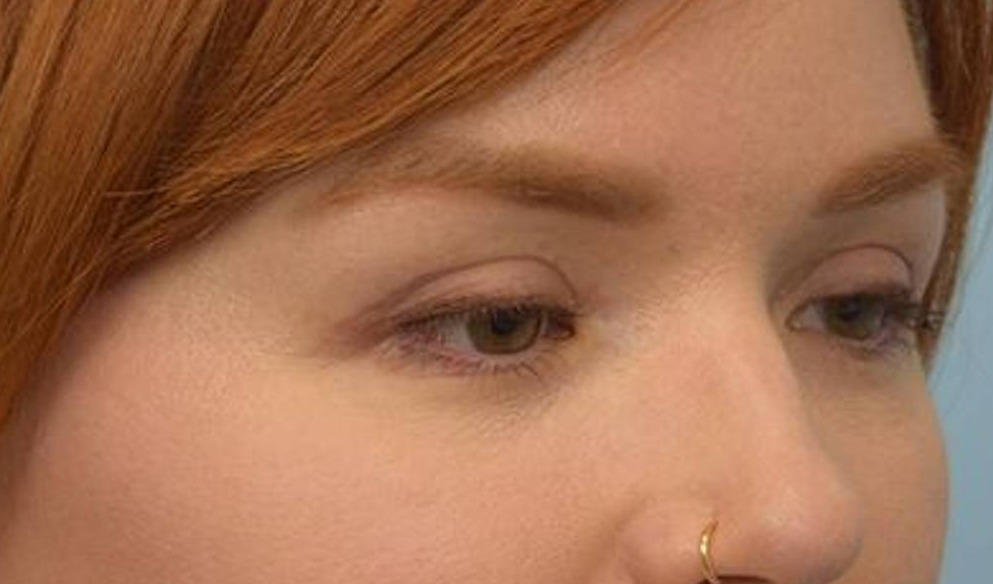 Blepharoplasty Before & After Image