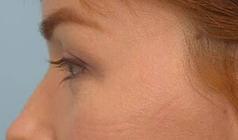 Blepharoplasty Before & After Image