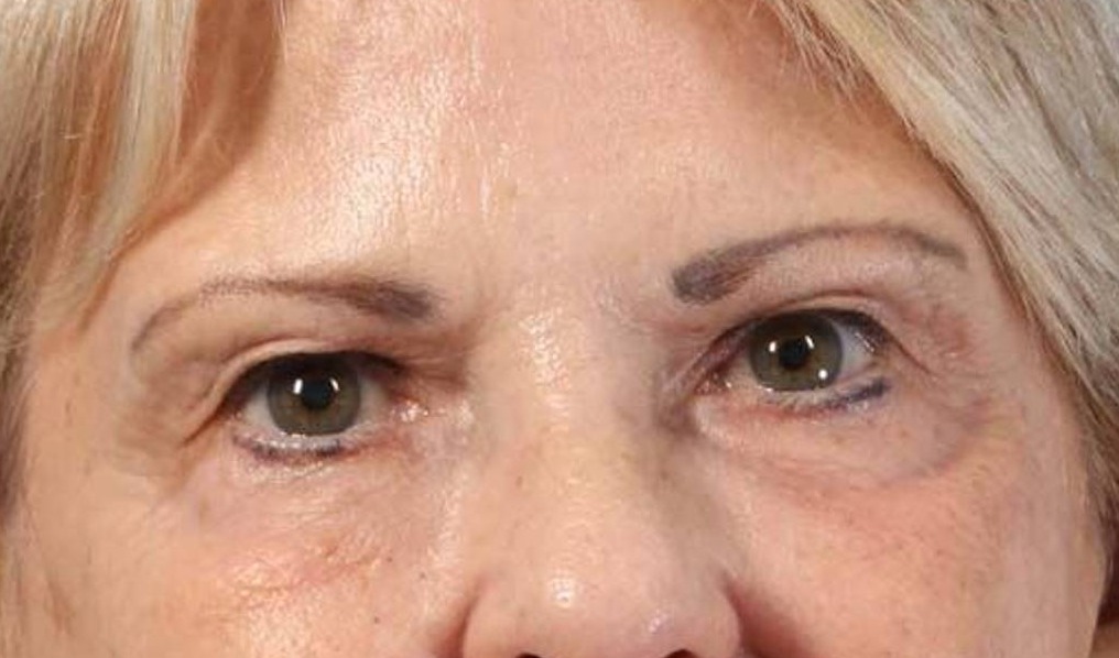 Blepharoplasty Before & After Image