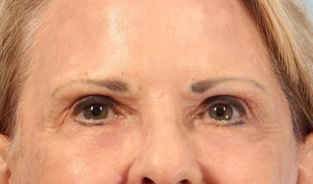 Blepharoplasty Before & After Image