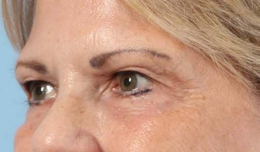 Blepharoplasty Before & After Image