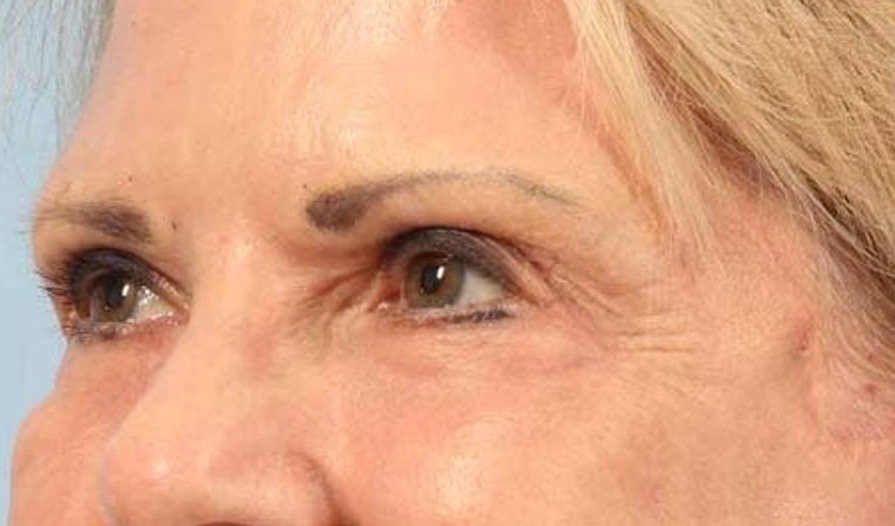 Blepharoplasty Before & After Image