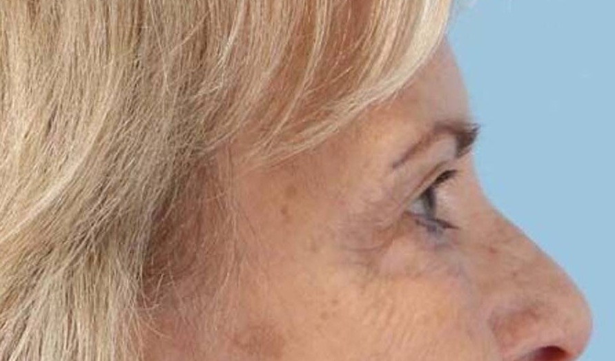 Blepharoplasty Before & After Image