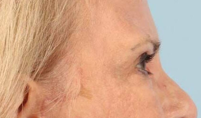 Blepharoplasty Before & After Image