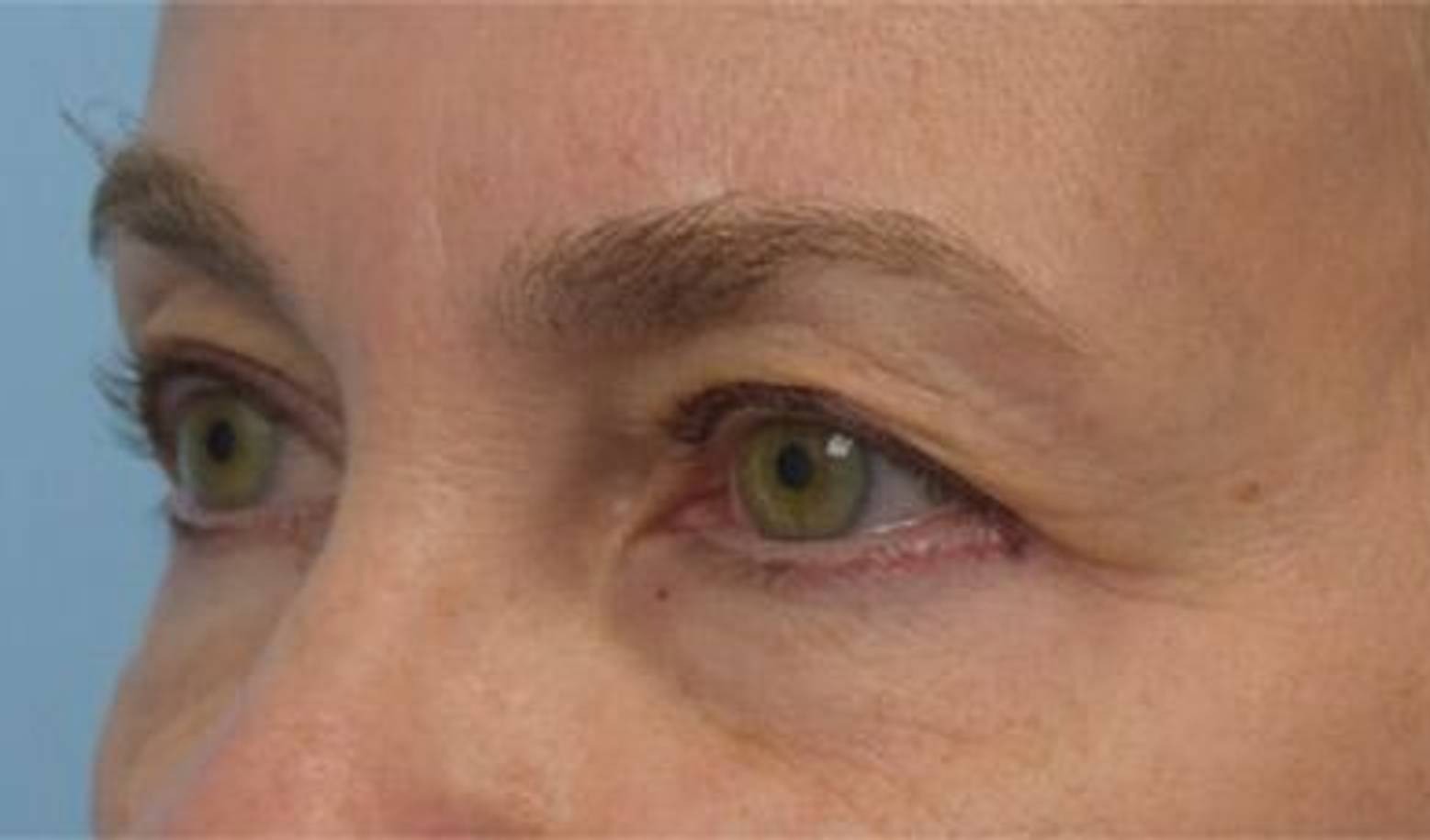 Blepharoplasty Before & After Image