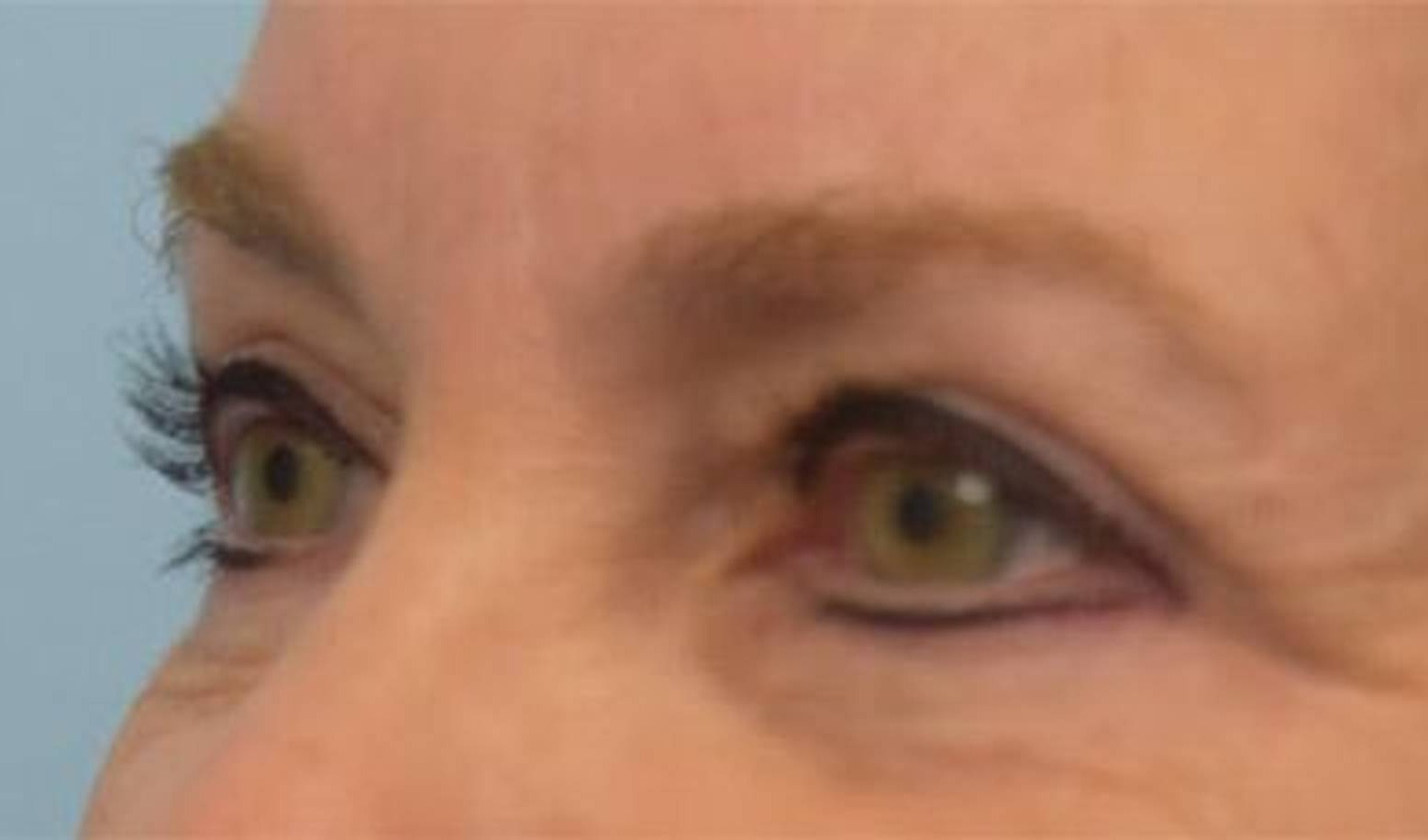 Blepharoplasty Before & After Image