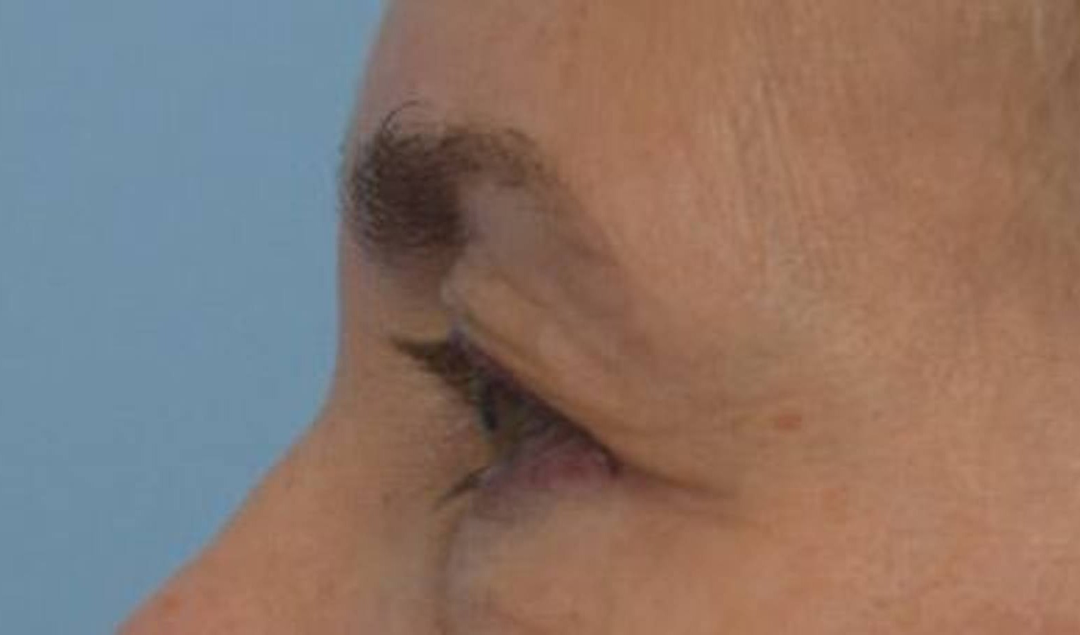 Blepharoplasty Before & After Image