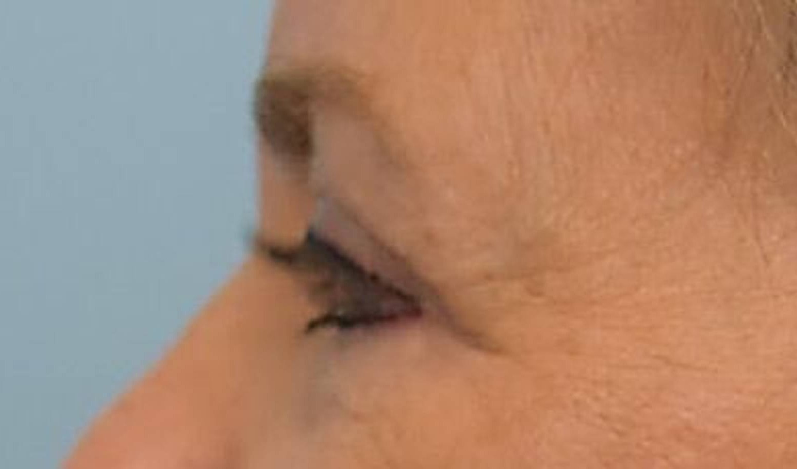 Blepharoplasty Before & After Image