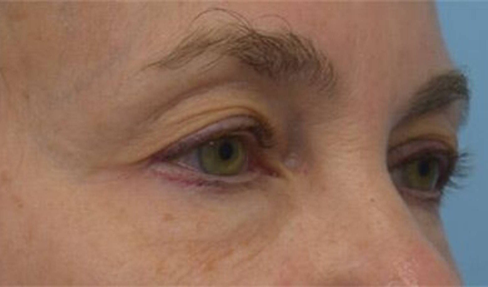 Blepharoplasty Before & After Image