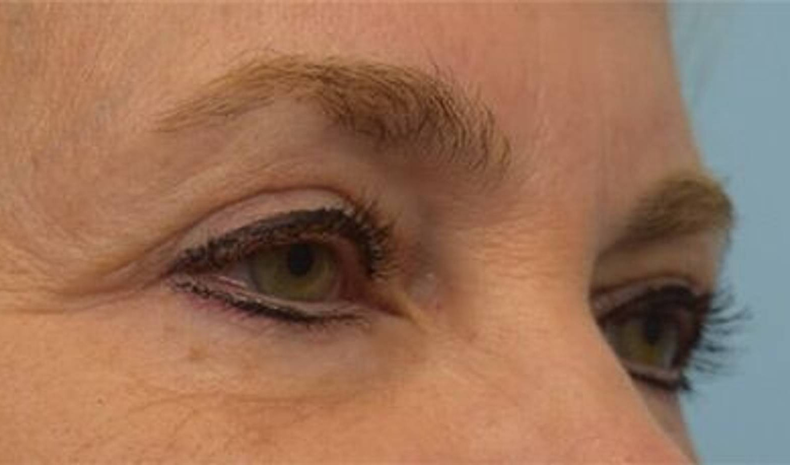 Blepharoplasty Before & After Image