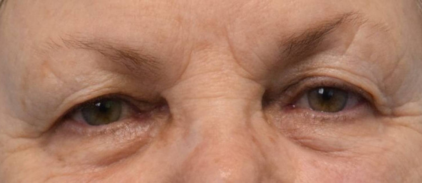 Blepharoplasty Before & After Image