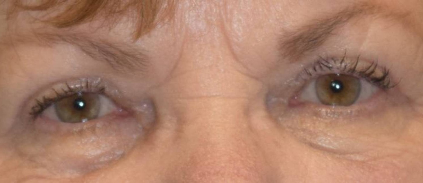 Blepharoplasty Before & After Image