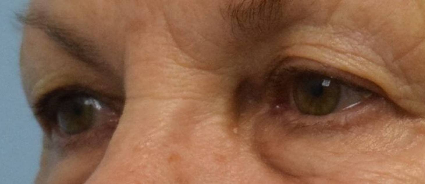 Blepharoplasty Before & After Image