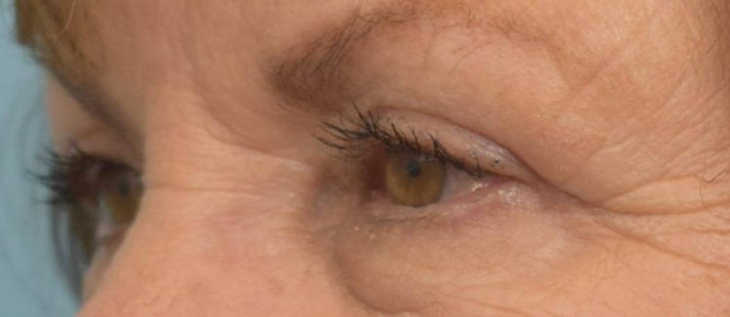 Blepharoplasty Before & After Image