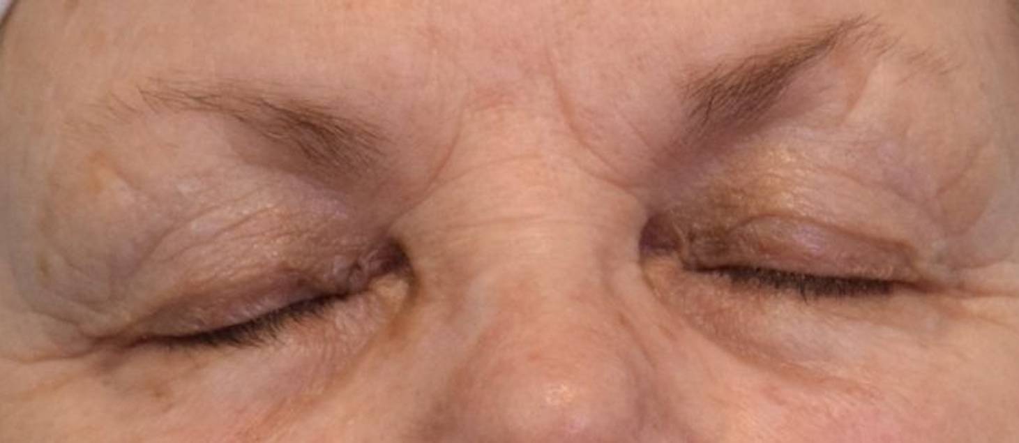 Blepharoplasty Before & After Image