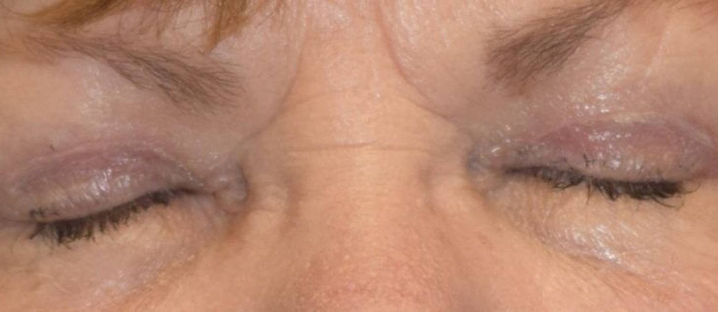 Blepharoplasty Before & After Image