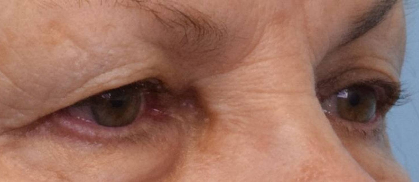 Blepharoplasty Before & After Image