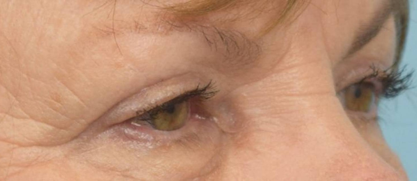 Blepharoplasty Before & After Image