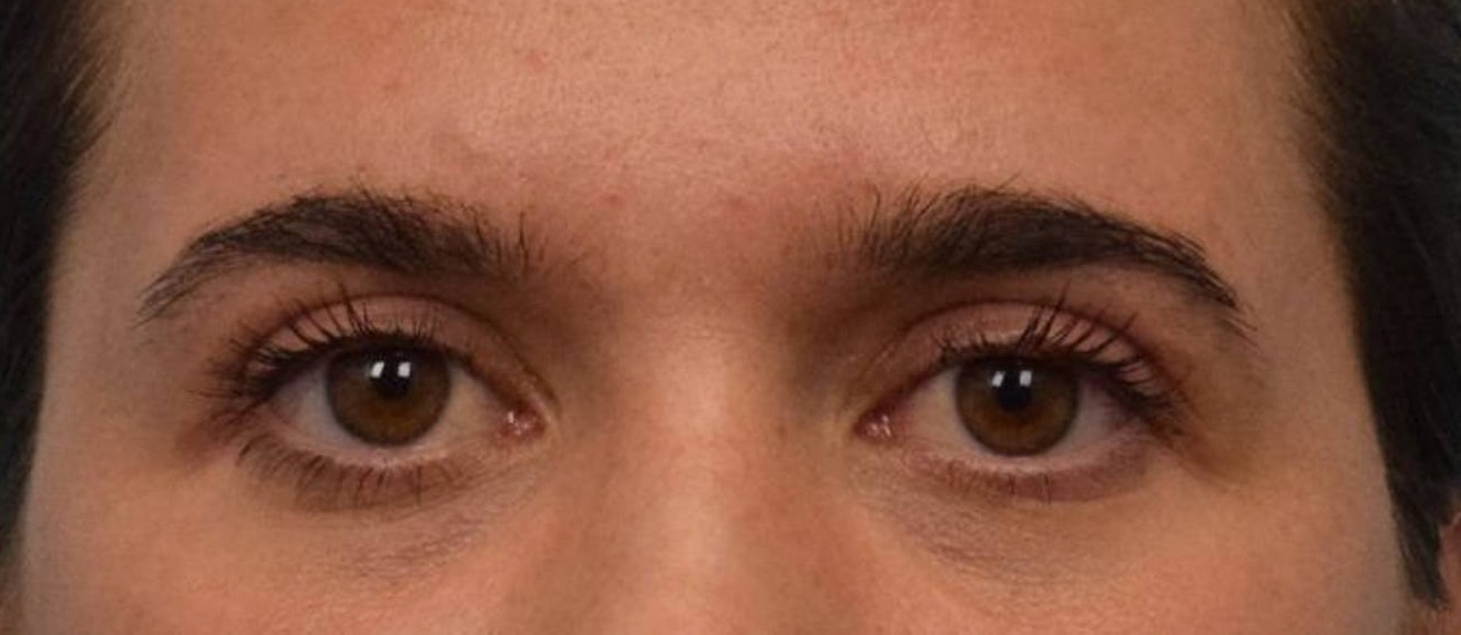 Blepharoplasty Before & After Image