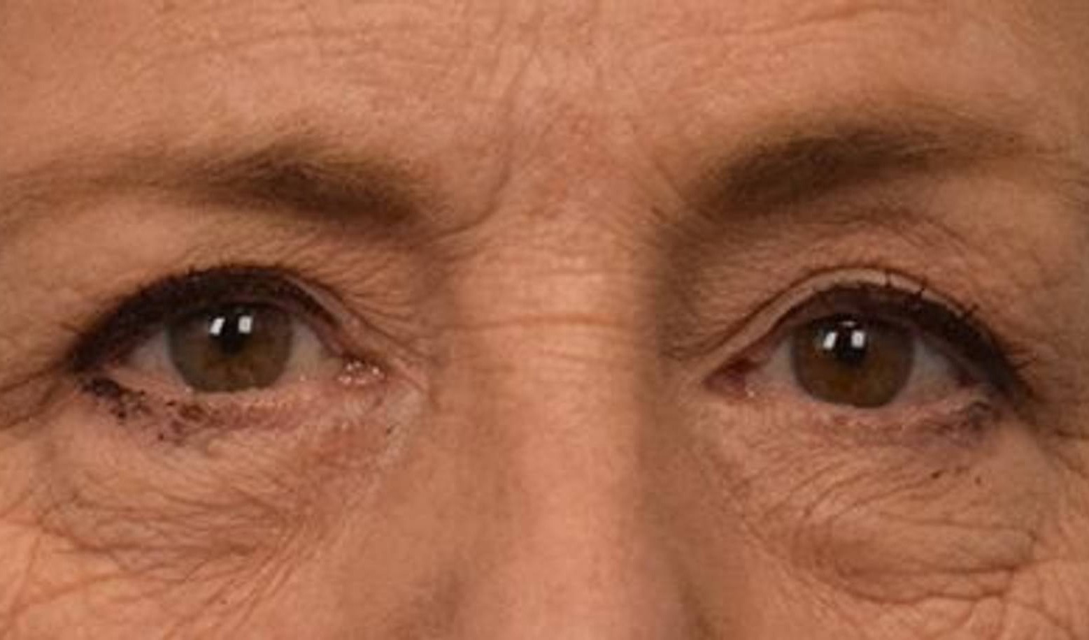 Blepharoplasty Before & After Image