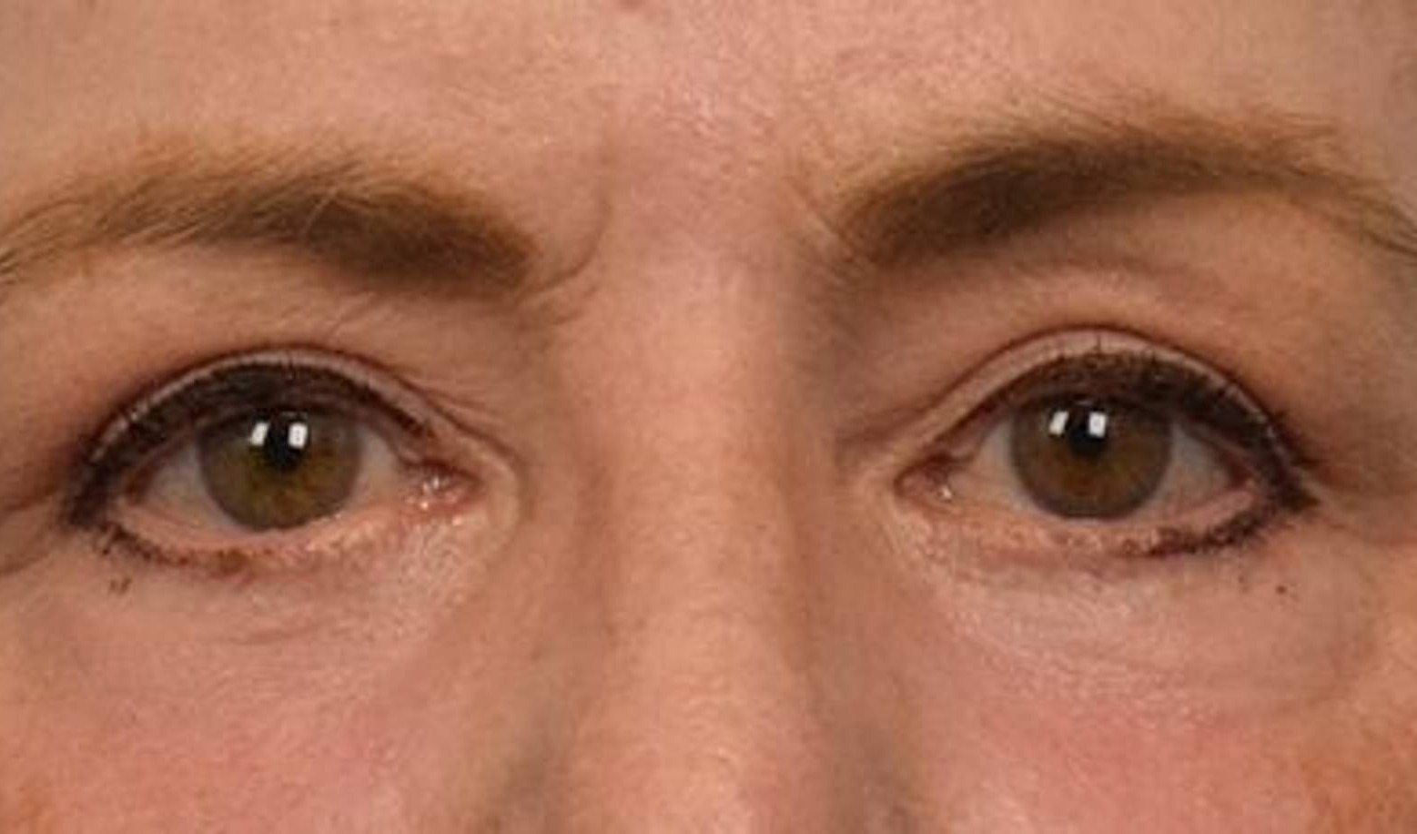 Blepharoplasty Before & After Image