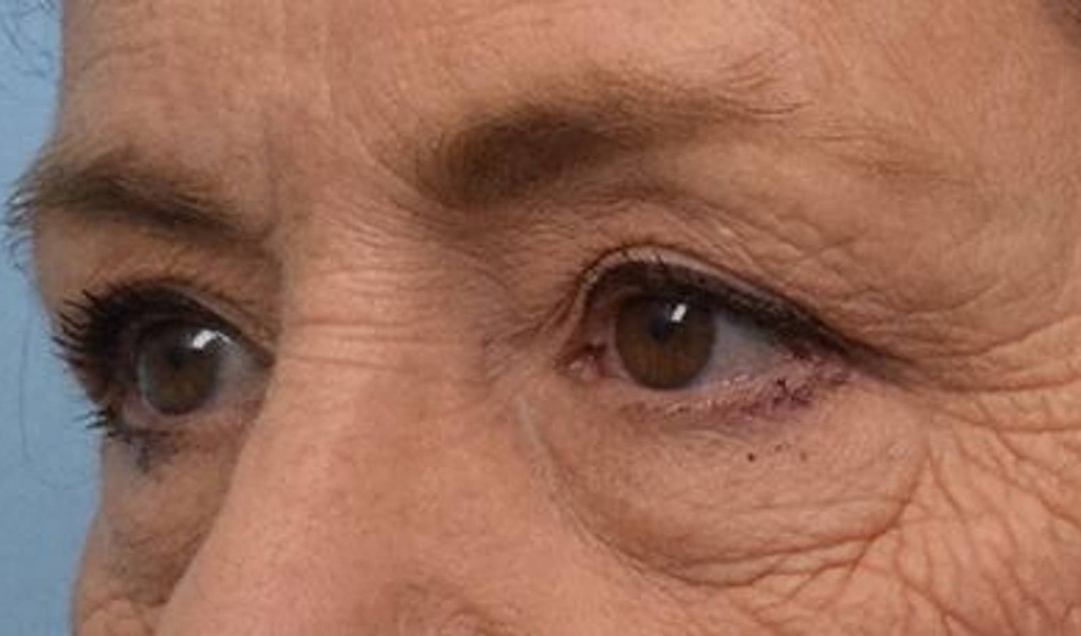 Blepharoplasty Before & After Image