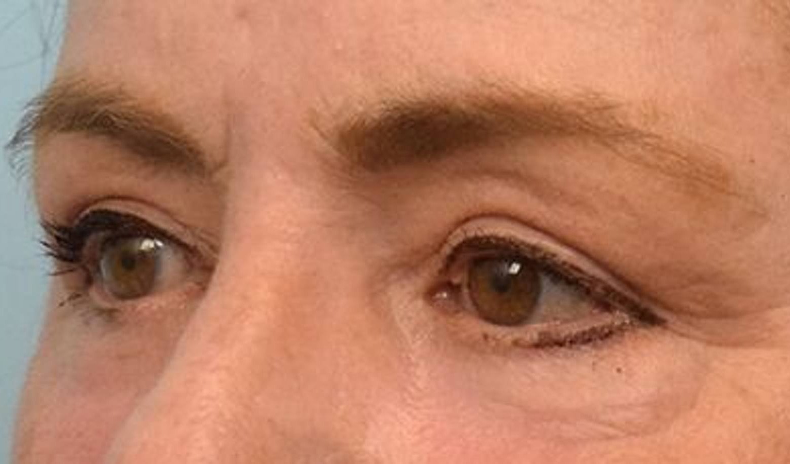 Blepharoplasty Before & After Image