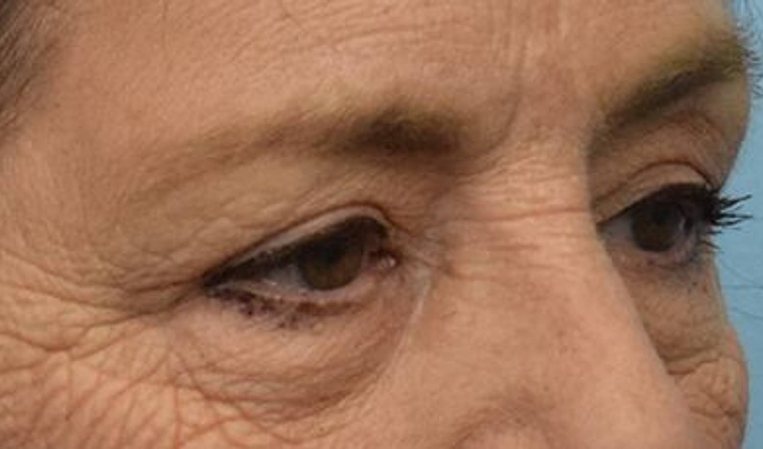 Blepharoplasty Before & After Image