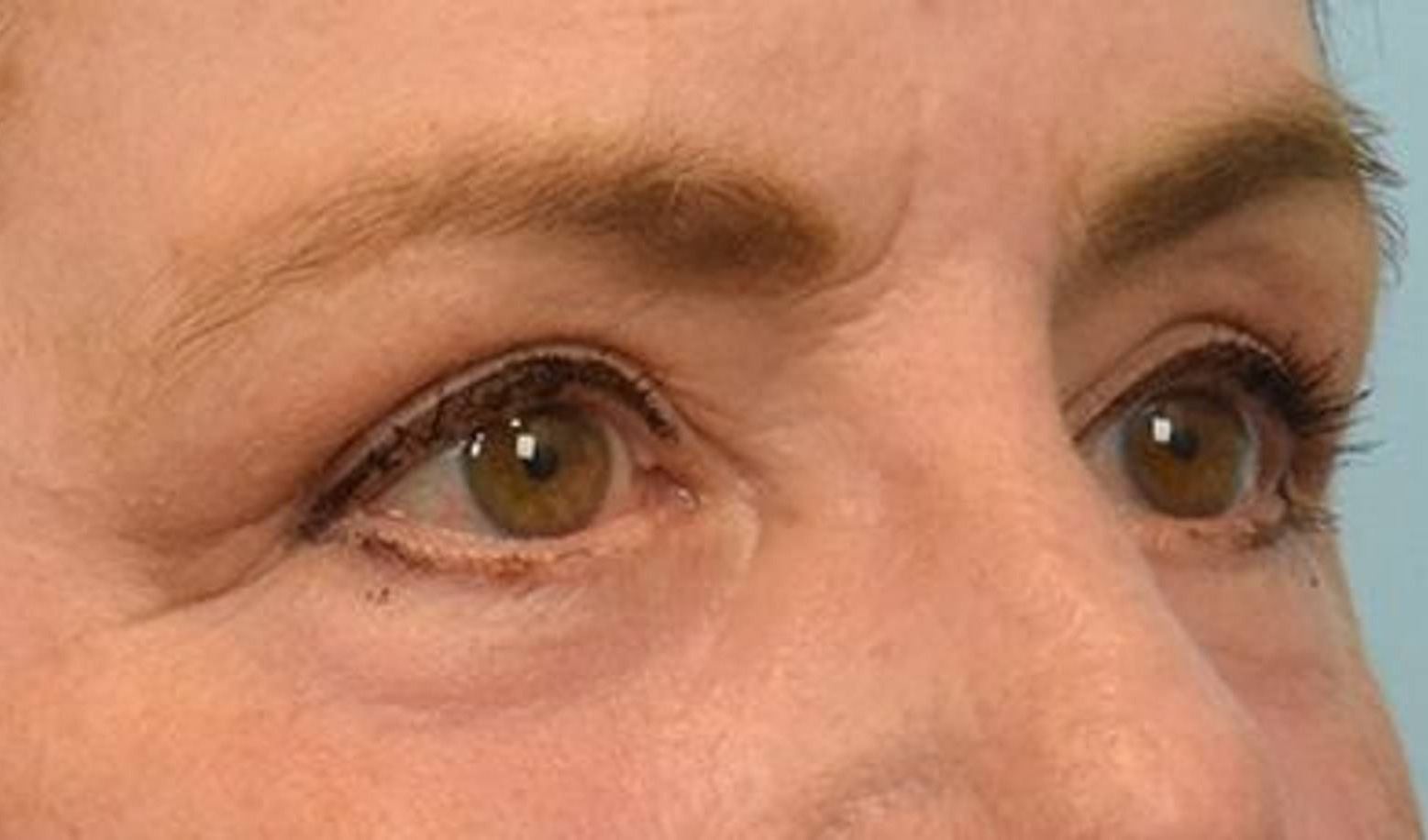 Blepharoplasty Before & After Image