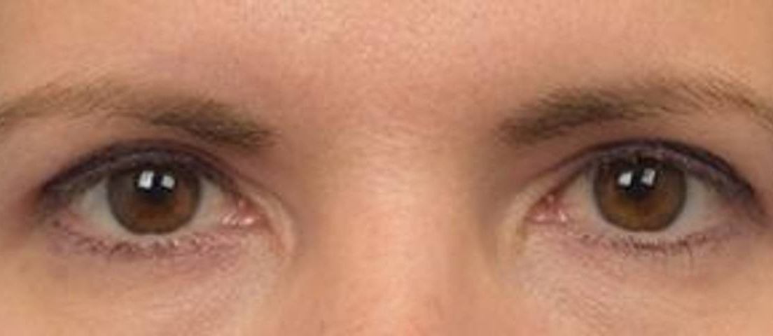 Blepharoplasty Before & After Image