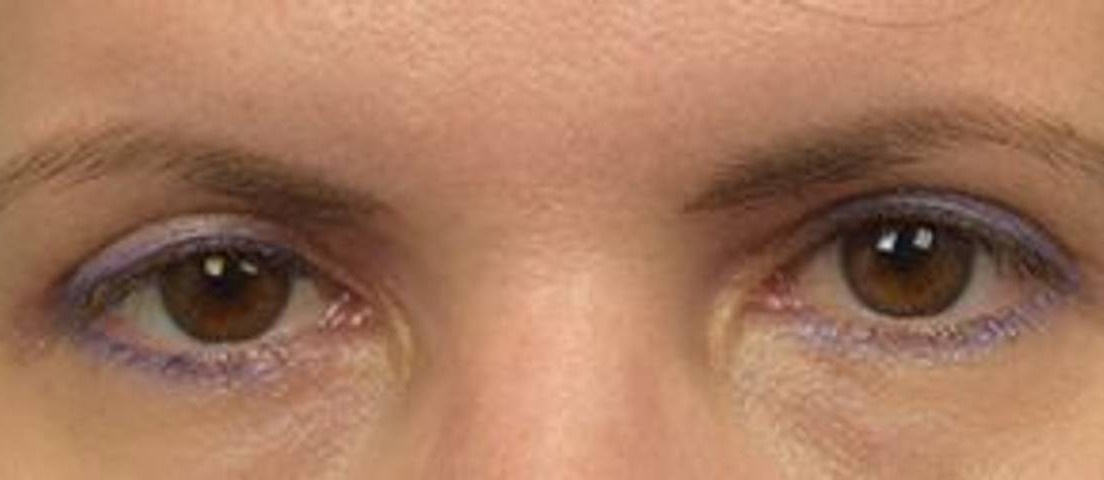 Blepharoplasty Before & After Image