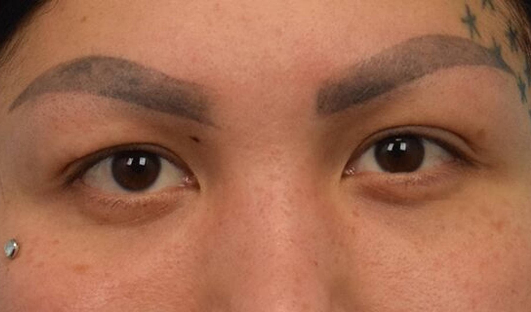 Blepharoplasty Before & After Image