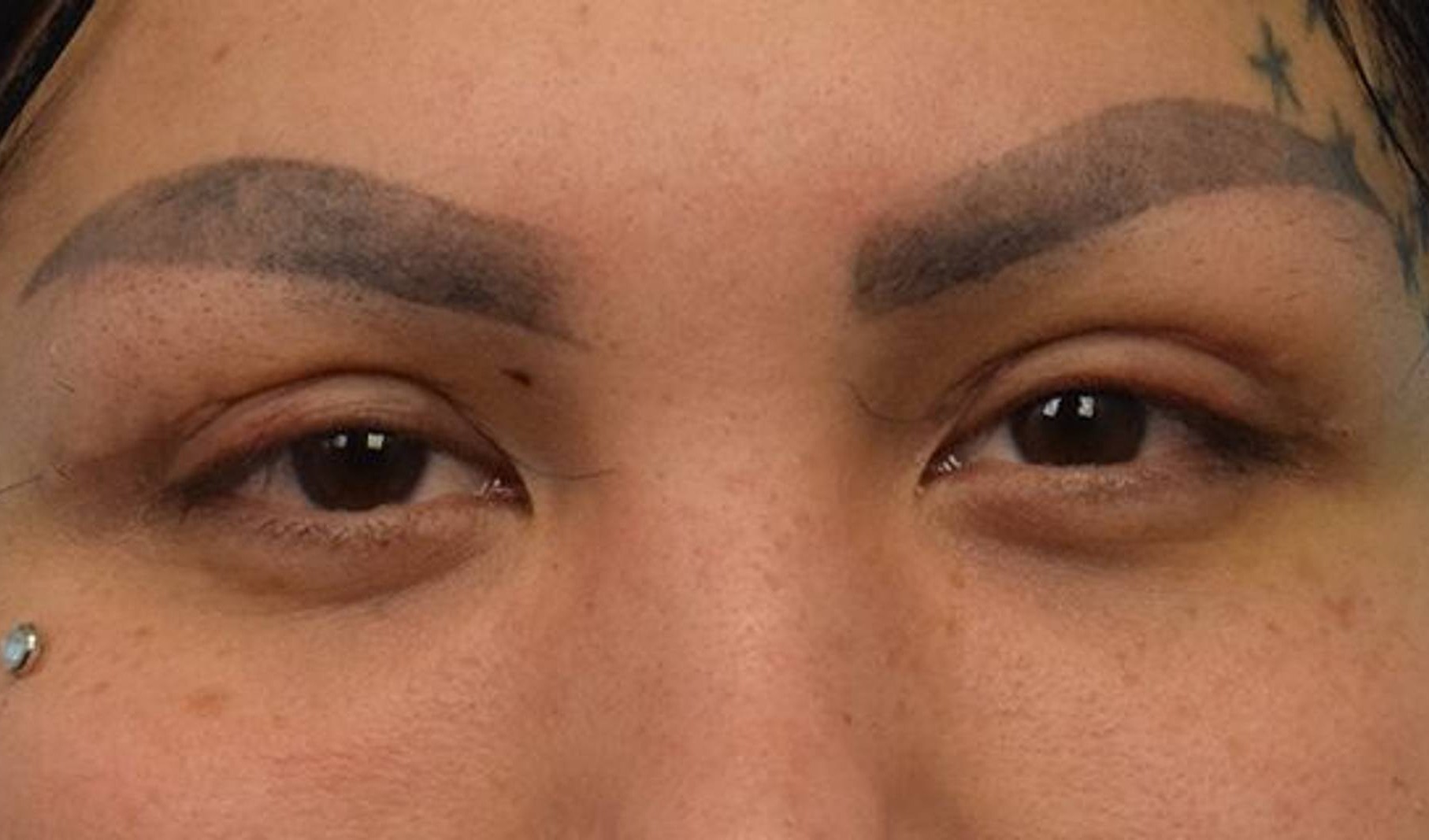 Blepharoplasty Before & After Image