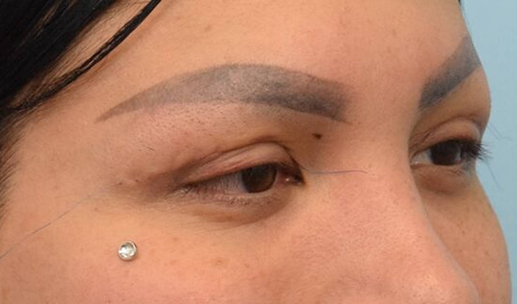 Blepharoplasty Before & After Image