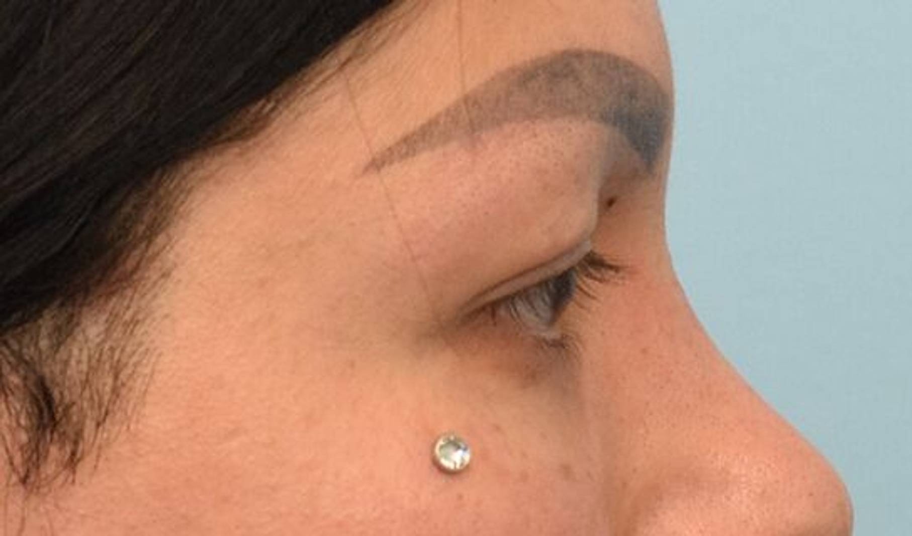 Blepharoplasty Before & After Image