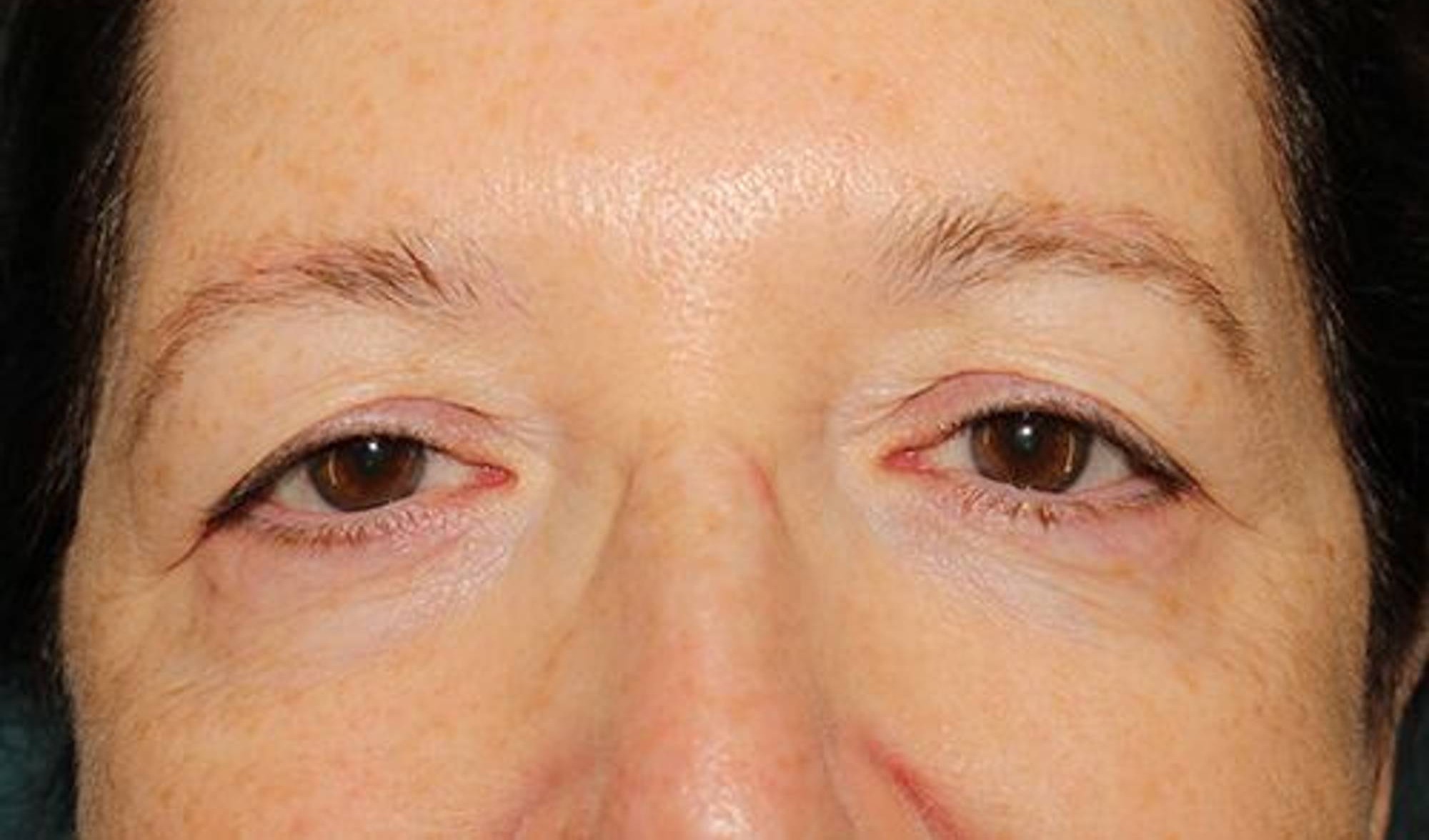 Blepharoplasty Before & After Image