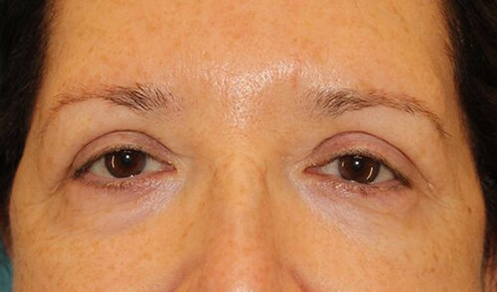 Blepharoplasty Before & After Image