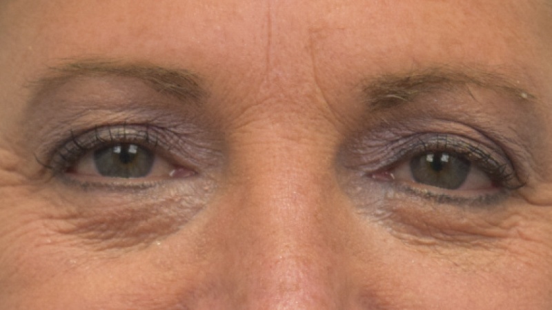 Blepharoplasty Before & After Image