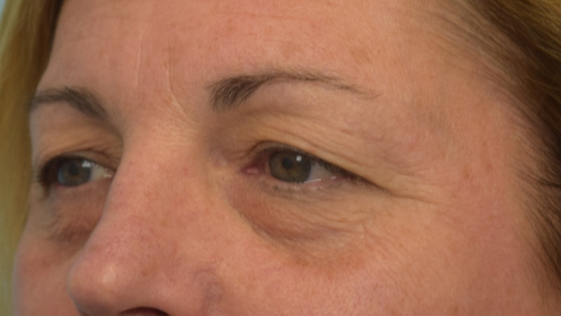 Blepharoplasty Before & After Image