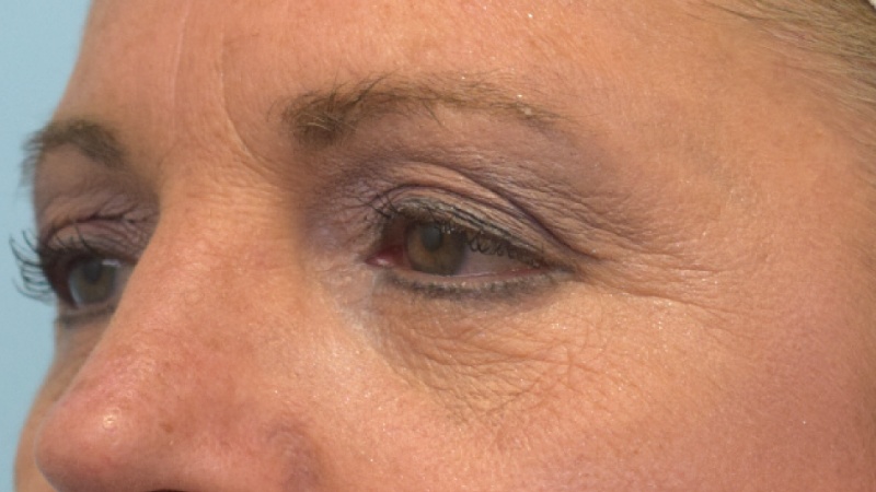 Blepharoplasty Before & After Image